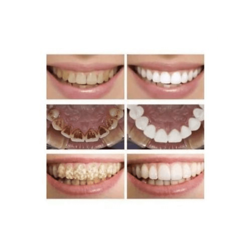 LANBENA Teeth Whitening Blanchiment Dentaire