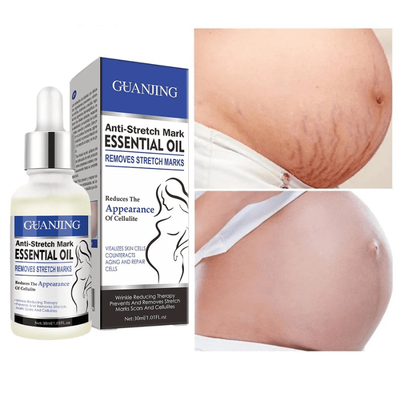 Anti-Stretch Mark ESSENTIAL OIL REMOVES STRETCH MARKS